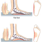 Flat feet